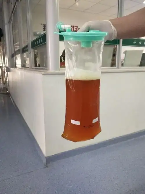 宜春市人民医院内科胸腔镜诊断和治疗一例大量胸腔积液患者