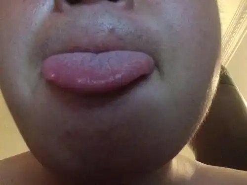 舌头上长了一个小肉疙瘩,差不多有一年了,平时不痛不痒的,就是最近一