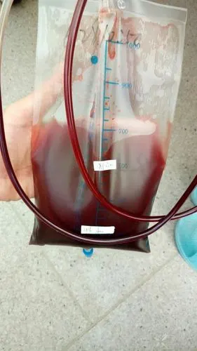 加重伴胸闷1月入院,ct检查示:右下肺不张伴实变,右侧包裹性胸腔积液