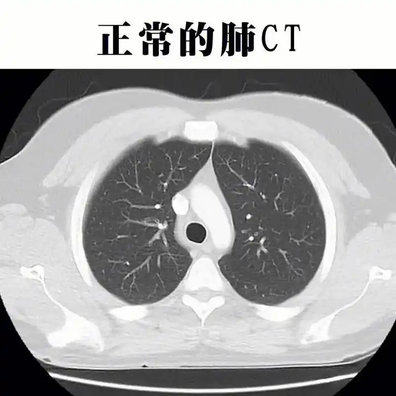 166图一:正常的肺ct 266图二:肺结节(外围磨玻璃影) 3 - 抖音