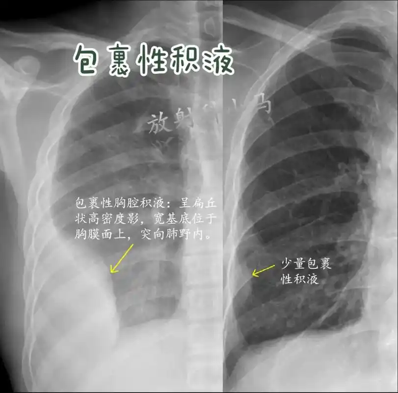 包裹性胸腔积液:呈扁丘状高密度影,宽基底位于胸膜 - 抖音