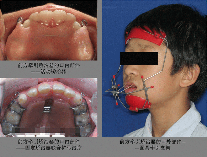 三,头帽颏兜牵引矫治器