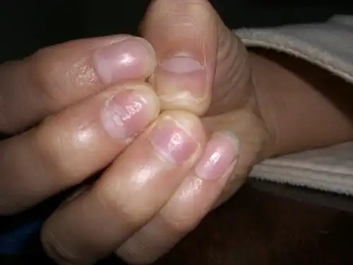 指甲这样是什么原因(有图,去医院查过不是灰指甲)