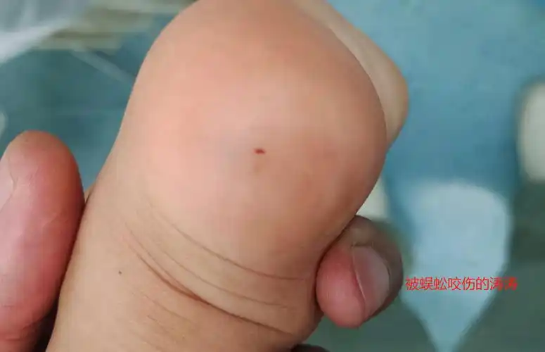 皮肤科湿热天气千万注意2岁8月娃娃在家被7cm蜈蚣咬伤