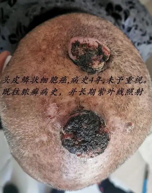 皮肤外科门诊之皮肤鳞状细胞癌_鳞状细胞癌_介绍_发病原因_治疗方式
