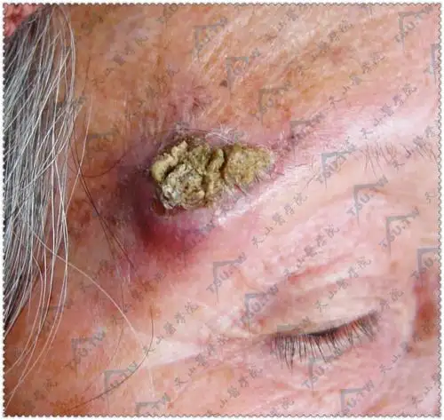 鳞状细胞癌(鳞癌,表皮样癌) - 皮肤病学 - 天山医学院