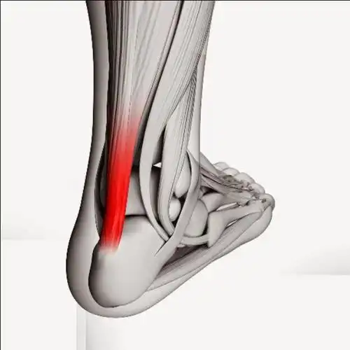 跟腱炎