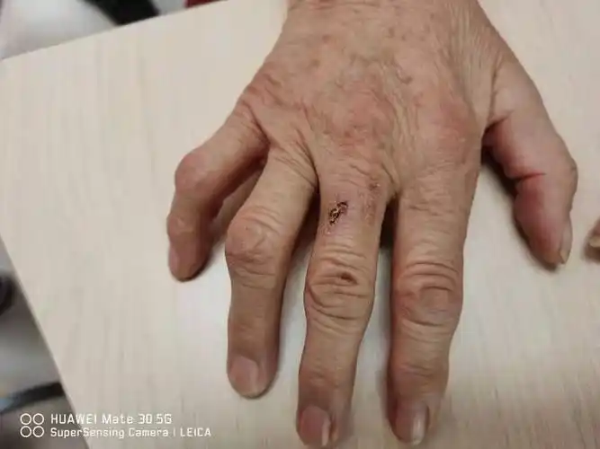 鸡爪手的噩梦——糖尿病周围神经病案例分享 - 微医(挂号网)