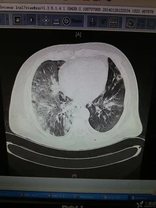 【影像读片】病毒性肺炎ct
