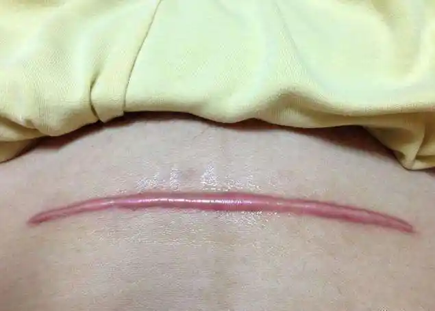 这条疤看起来像极了爬在肚子上的蚯蚓,要知道每个妈妈当他们还是小