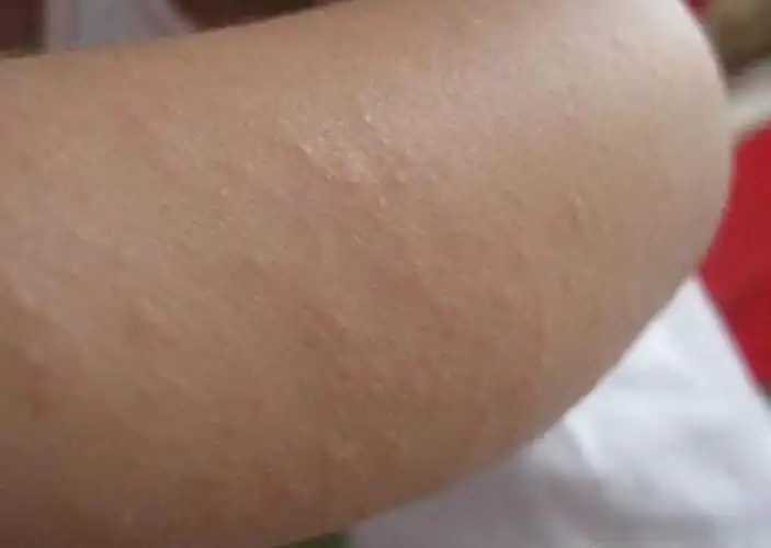 小儿常见皮肤病～摩擦性苔藓样疹(高清图文) - 好大夫在线