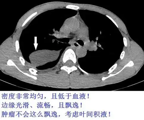 ct鉴别:疑难胸水,叶间胸水,复杂心包积液,现实中的胸水误诊病例