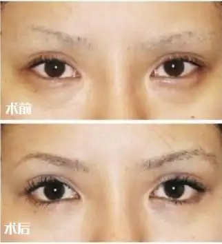 开外眼角和下睑下至,想变大眼的人必须知道的事