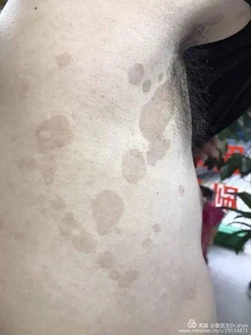 花斑癣,俗称汗斑... - 美篇