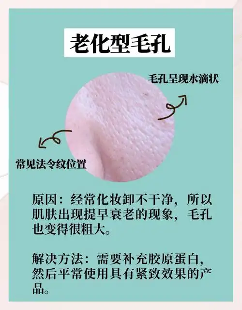 四种毛孔粗大类型,你是哪一种?