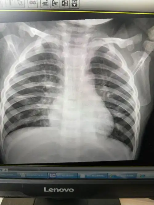 肺炎伴左下肺节段性不张4.22