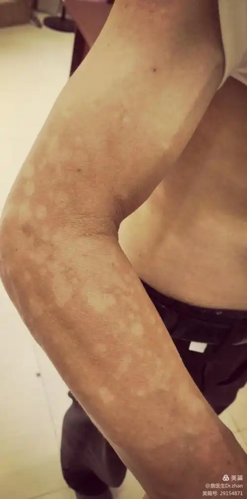 又称为花斑癣,汗斑.