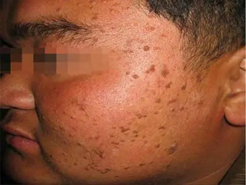 丝状疣的对比图片