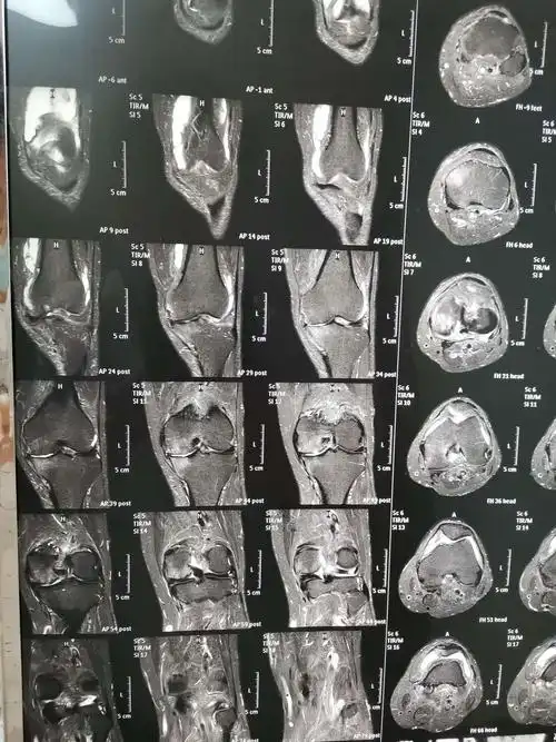 膝关节内侧皱襞综合征