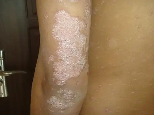 体癣图片_体癣症状表现图片大全_有来医生