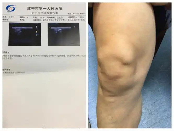 彩超显示未累及膝盖骨,位于皮下的肿瘤,是何种肿瘤?良性,恶性?