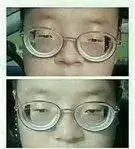 18岁,今年1000度近视,父亲为了给我治眼睛花了至少10多万了.