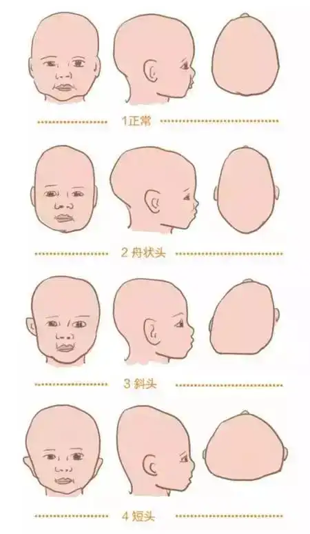 其实,这是新生儿头颅血肿,是由于分娩进程中产道挤压,招致颅骨骨膜下