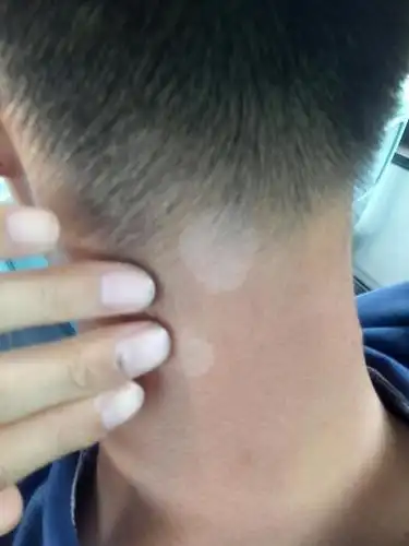 是白癜风还是汗斑?