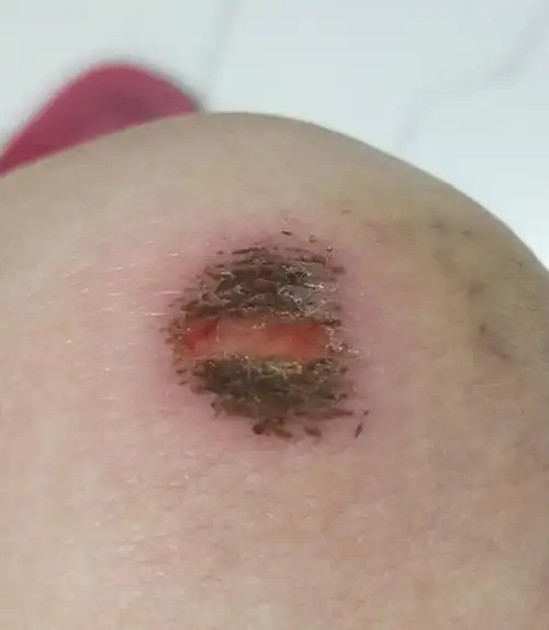 贴(云南白药的)后来看伤口可能不小心擦破了,疤痕有点凸起,露出了血