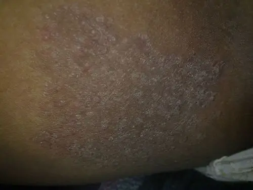 大腿根有红块,痒的很