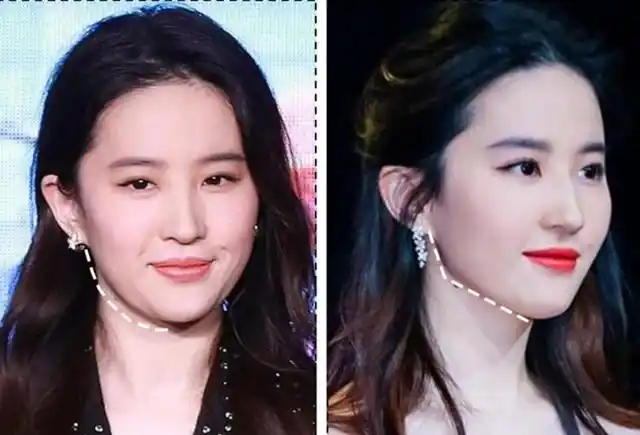 苹果肌下垂图片对比图