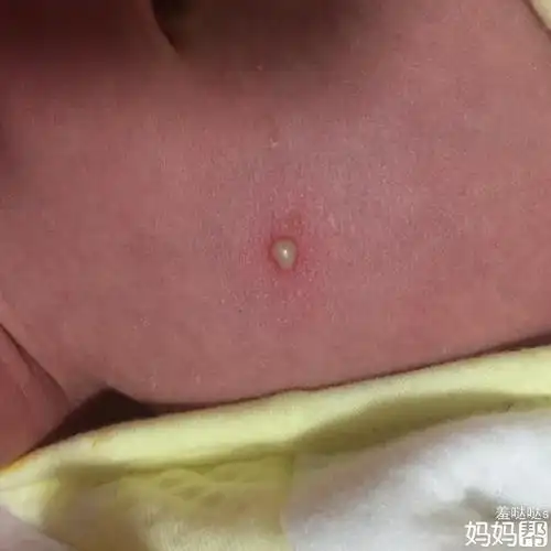 娩出过程中,如果产妇阴道内的病菌侵入婴儿眼中,便可发生新生儿结膜炎