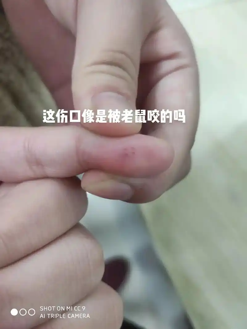 晚上半夜女儿说她手指痛,流血啦,起来看,是被不明东西咬的,开 - 抖音