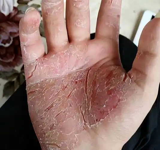 或许是方法没用对,这样做才能彻底搞定!_皮肤_效果_裂口