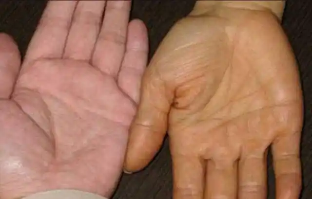 这些多余的胆红素进入血液循环系统,引起黄疸,从而出现皮肤发黄的情况