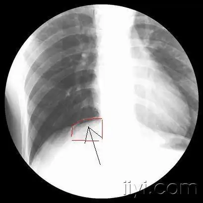 弱弱的问问胃肠穿孔x线怎么看