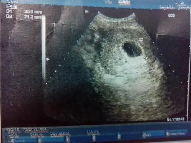 孕7周的孕囊照片,看看是男宝还是女宝啊