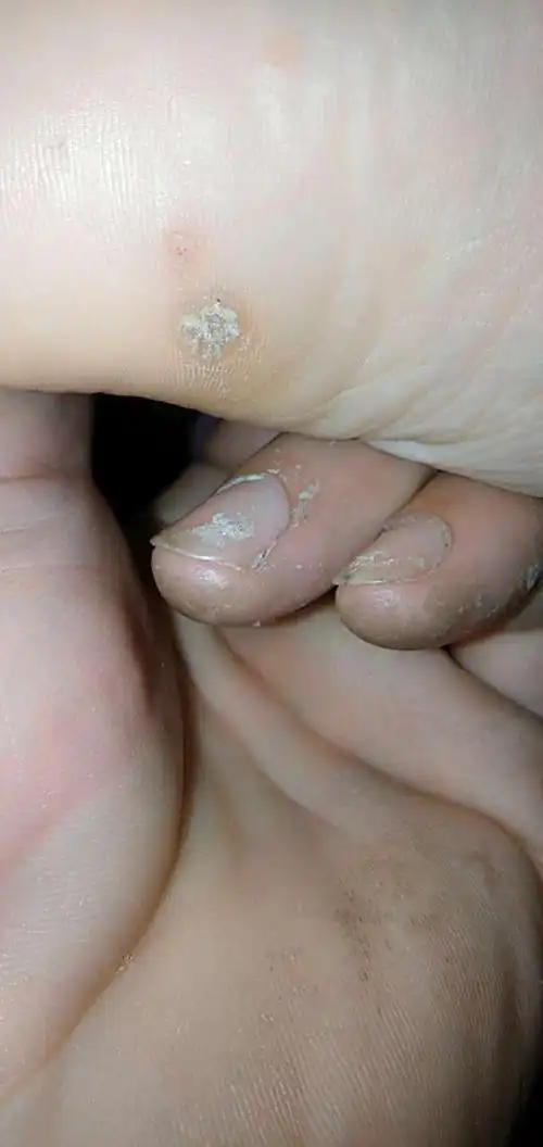 鸡眼长什么样子图片 鸡眼图片初期症状