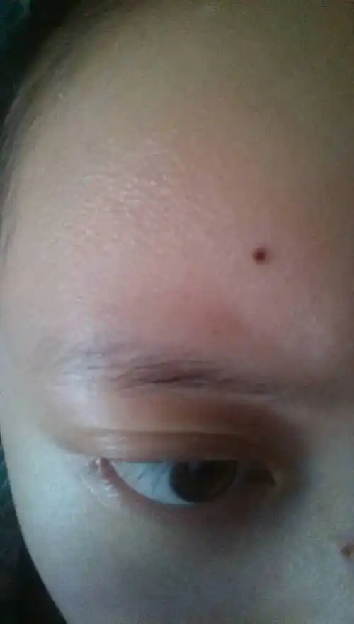 药水点痣一周了这个痣还没有结痂,只是凹下去一个坑.怎么回事.