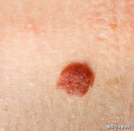 身上有这种小红痣,千万别大意,或是大病的预警信号_手机搜狐网