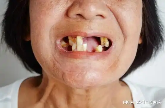 掉牙无门60岁男子试图拔掉全口牙专家提醒千万别去拔牙