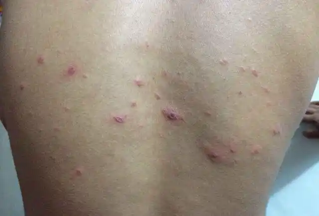 身上长螨虫的症状图片(后背抠下脂肪粒) - 赤虎壹号