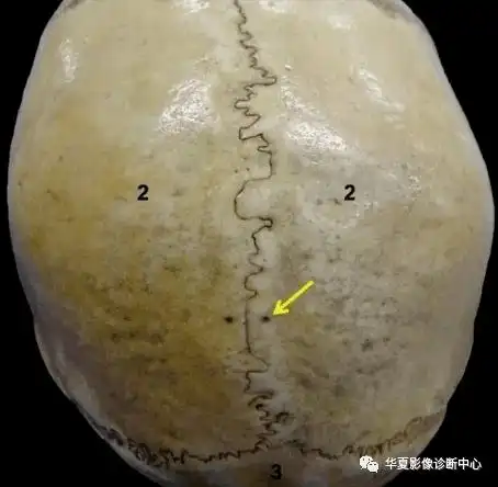 影像基础颅骨这些变异不要误认为是病变