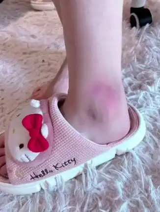 卖惨蔡萝莉送外卖崴脚右脚变左脚遭质疑网友看看眼科