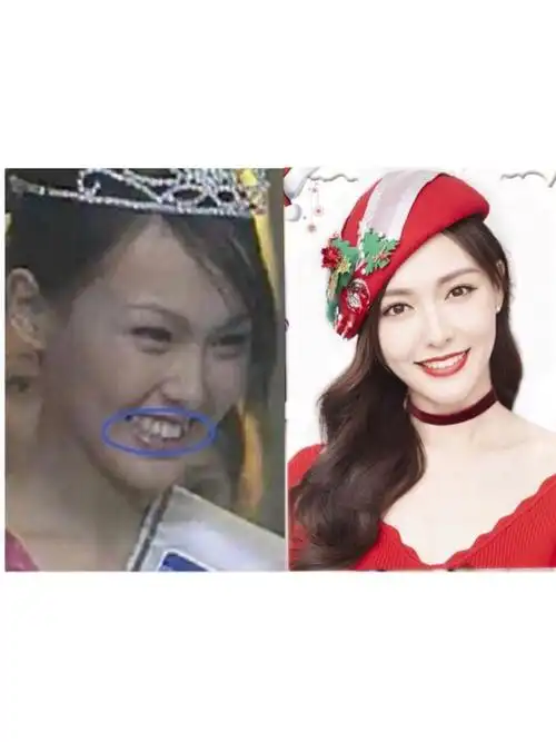 【整形前必看篇】整牙堪比整容?