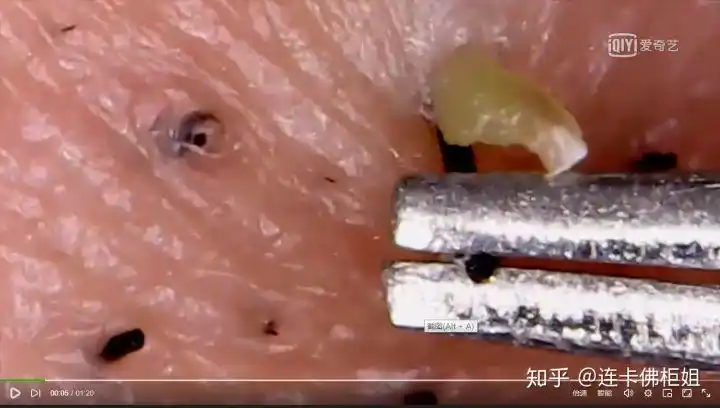 为什么每天洗脸还有黑头