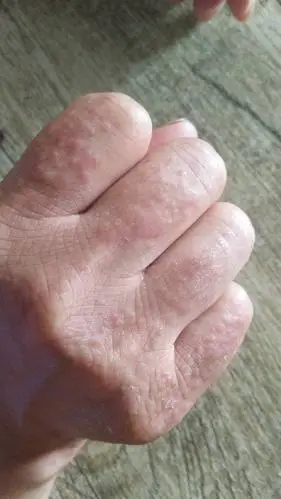 我手上都是小红点,很痒,起很久了,越来越多,请问这是热毒吗?