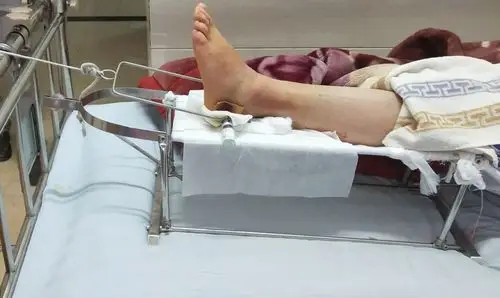 跟骨持续牵引