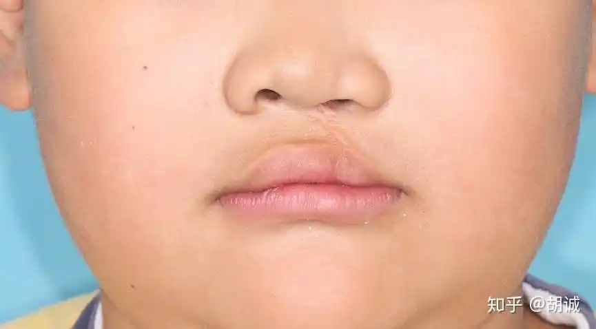 孕妈们四维要是检查出胎儿唇腭裂你们会不会要? - 知乎