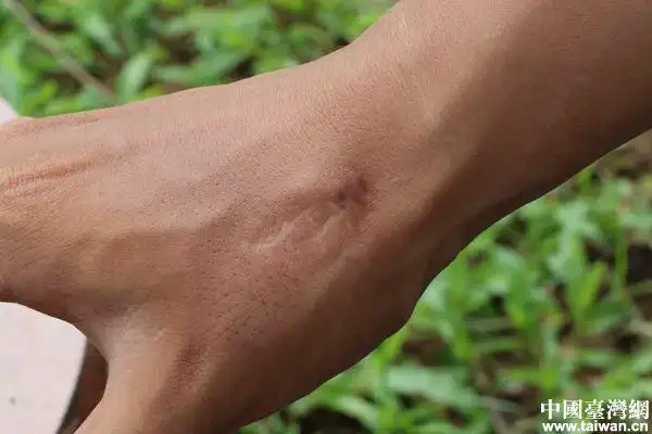 孔凡宾手腕上的伤疤.(中国台湾网 尹赛楠 摄)